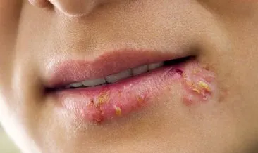 dudaktaki ucuklar nasil gecer neden