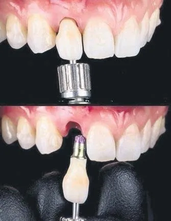 implant uygulamalarinda altin cag