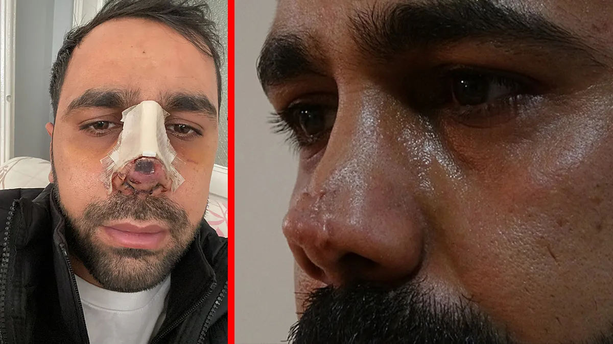 Diyarbakır’da estetik faciası! Burun ameliyatı sonrası hayatı karardı: ‘İnsanların yüzüne bakamıyorum'