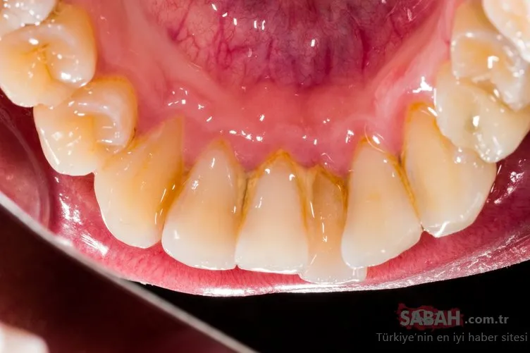 Diş taşı, diş kaybına neden olabilir!