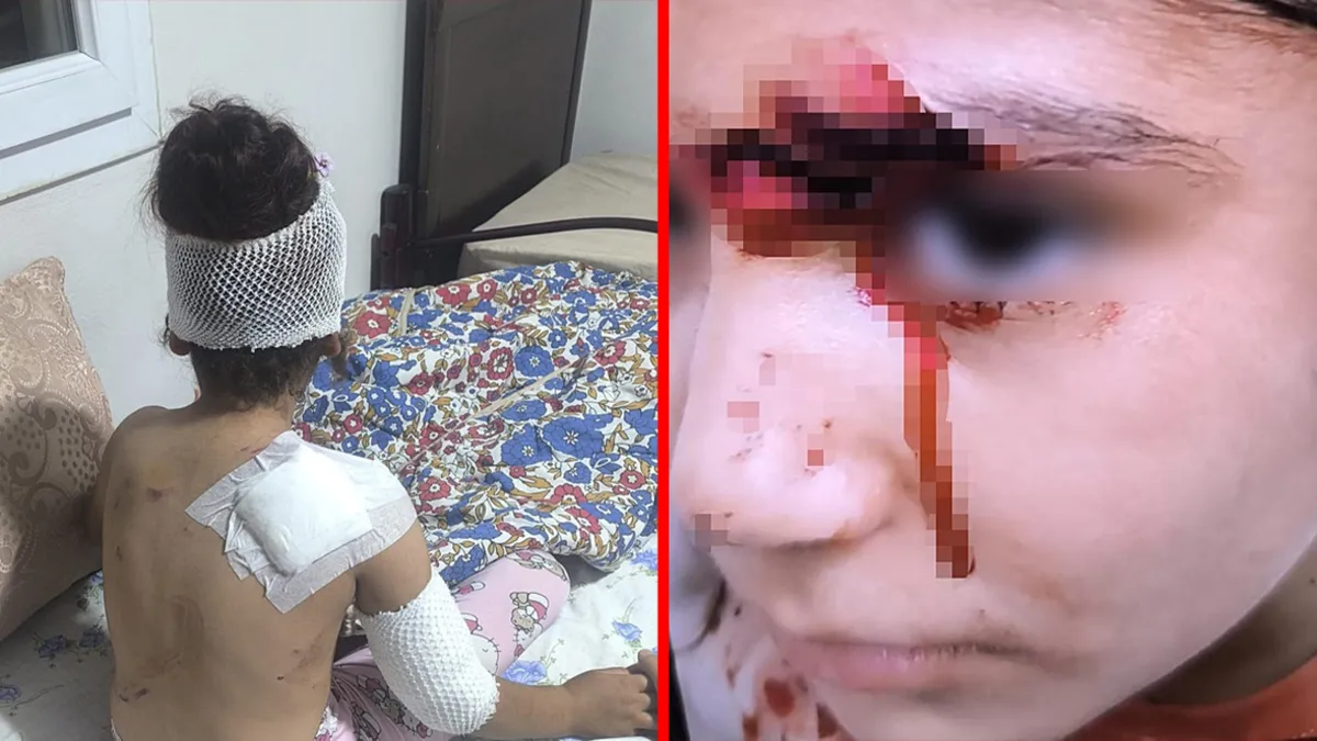 Şanlıurfa’da başıboş köpek dehşeti! 8 yaşındaki çocuğa saldırdılar: 150 dikiş atıldı! Şanlıurfa’da başıboş köpek dehşeti! 8 yaşındaki çocuğa saldırdılar: 150 dikiş atıldı!