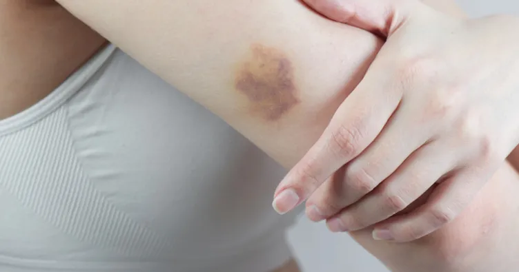 Morluk nasıl geçer? Morluğa ne iyi gelir? İşte morluklara anında ve kesin çözüm yöntemleri