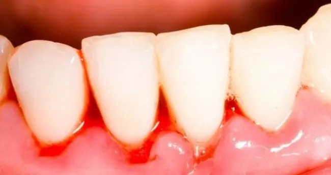 dis eti kanamasi neden olur nasil tedavi edilir saglik haberleri