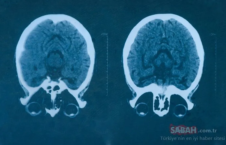 Beyin kanaması belirtileri nelerdir? İşte beyin kanamasının 10 kritik belirtisi...