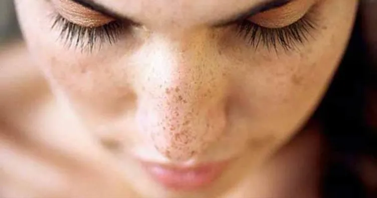 Güneş lekeleri nasıl geçer?