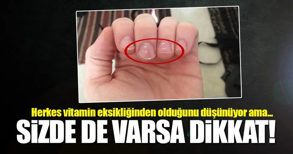 Tirnaklardaki Beyaz Lekelere Dikkat Sayfa 3 Saglik Haberleri