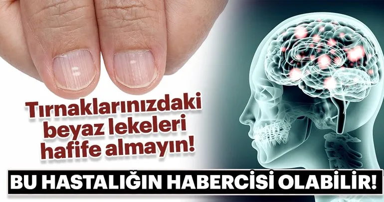 Tırnaklarınızdaki beyaz lekeleri hafife almayın!