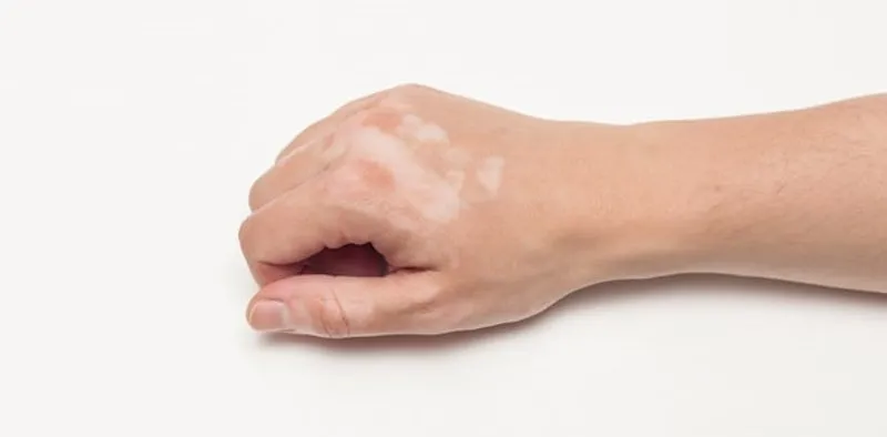 Vitiligo Nasil Gecer Son Dakika Haberler