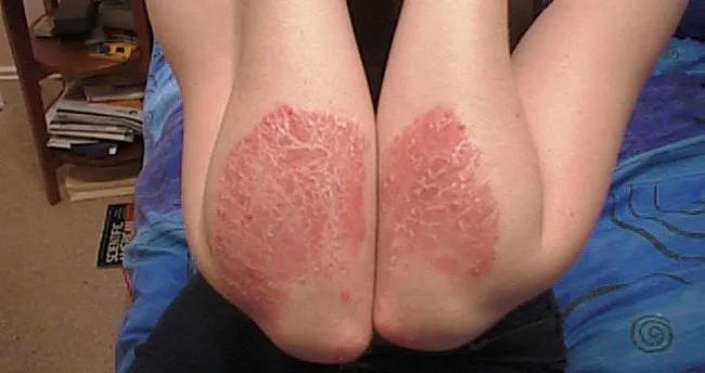 sedef hastaligi tedavisi nasil