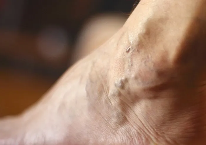 kan sulandirici kullanan varis tedavisi