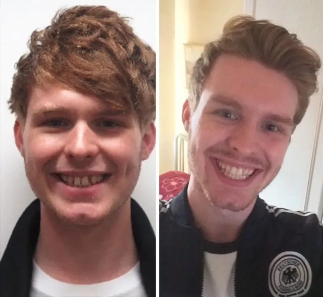 Diş teli taktırdıktan sonra bakın nasıl değiştiler!