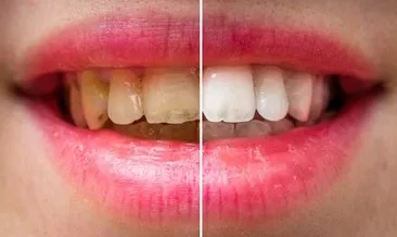 Bu yöntem sayesinde dişleriniz bembeyaz olacak! İşte dişleri beyazlatmanın doğal yolları