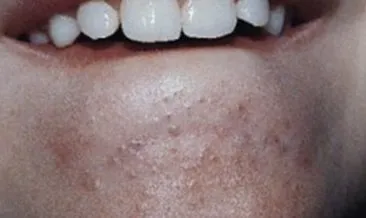 siyah noktalar nasil temizlenir siyah