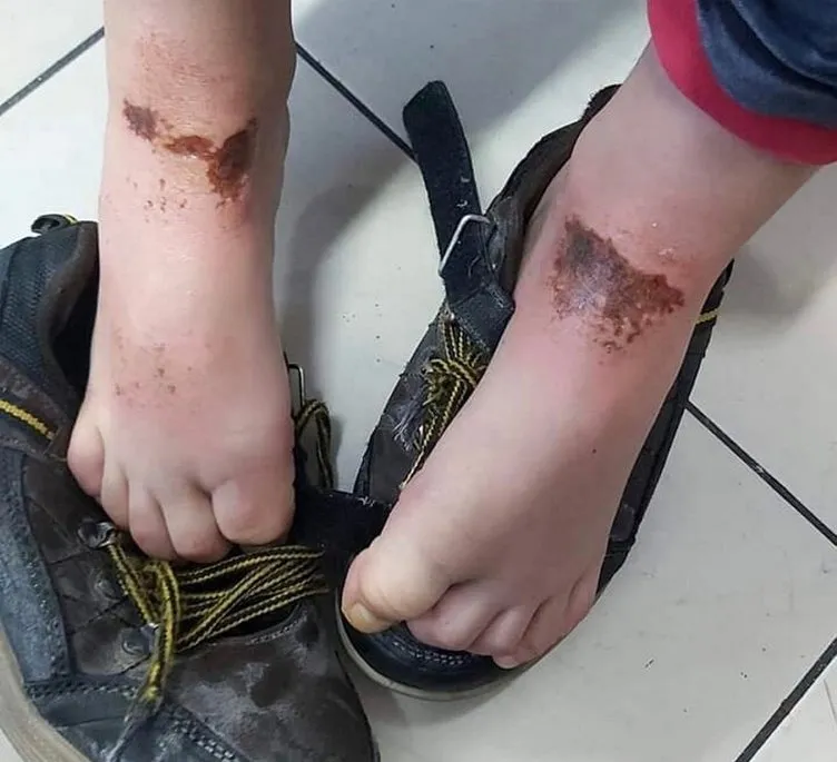 Kar topu oynarken vücutlarında yanık oluşan öğrencilerin sayısı 9'a çıktı