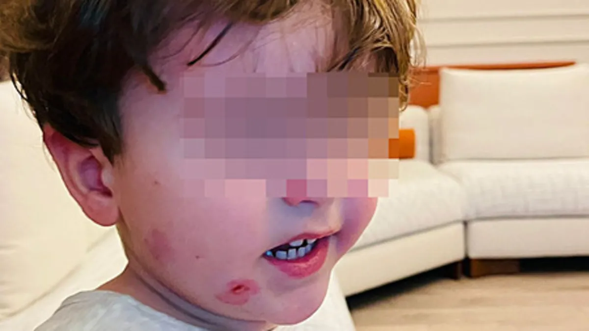 Kreşe bıraktığı çocuğunu darp edilmiş olarak geri aldı! Kreşe bıraktığı çocuğunu darp edilmiş olarak geri aldı!