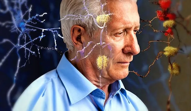 Alzheimer’a çare bulundu