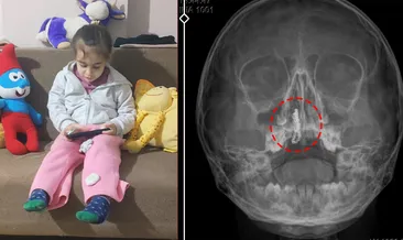 SON DAKİKA… Şiddetli kanama ve akıntı şikayetiyle gitti! Doktorlar bile şoka girdi: 5 yaşındaki Polen’in burnundan bakın ne çıktı! #rize