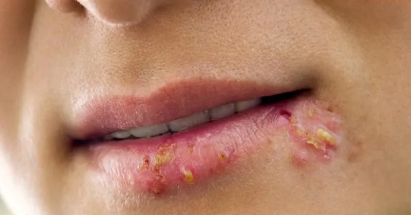 dudaktaki ucuklar nasil gecer neden olur saglik haberleri