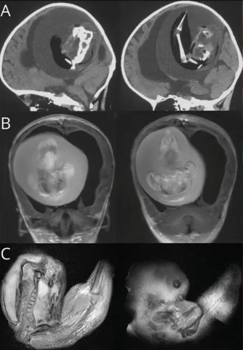 Çin’de akılalmaz olay! İkiz kardeşinin kafatasından çıkarıldı