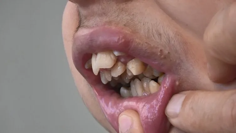 Liseli gencin yardım çığlığı: Alt çenesi yok dişleri üst damağında