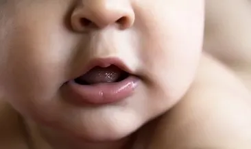 bebeklerde dudak bagi nasil tedavi edilir bebek haberleri