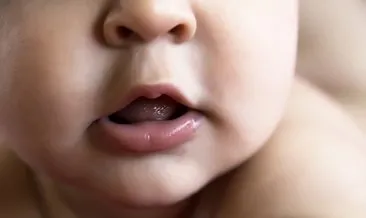 Bebeklerde dudak bağı sorunu nedir?