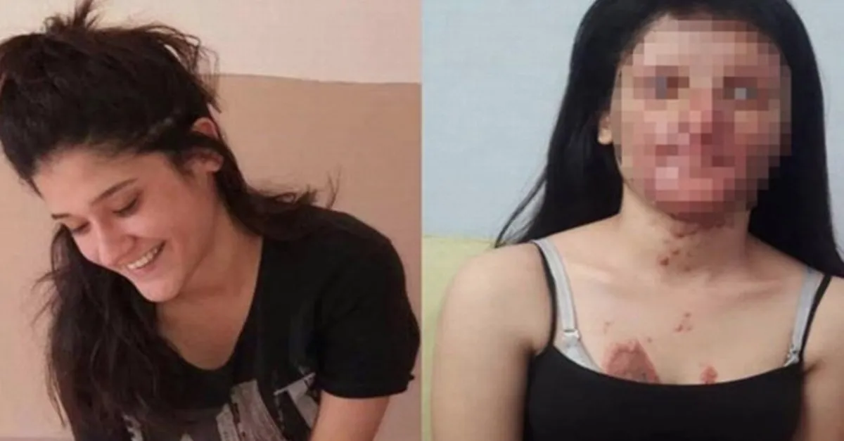 Yüzü asitle yanan Berfin Özek'den son dakika kararı!