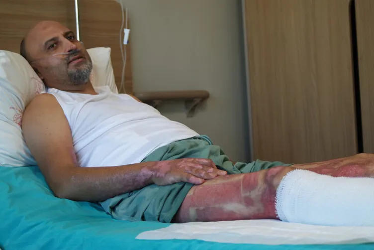 Mangal jeli öldürüyordu: Her tarafımın yandığını hissediyordum!