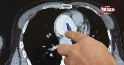 Mide ağrısı sandı, aort damarında yırtık çıktı | Video