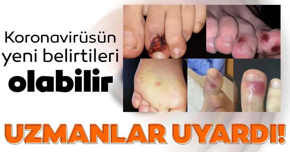 corona virusun yeni belirtileri