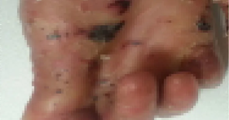 Bu hastalığın dünyada tam tedavisi yok!