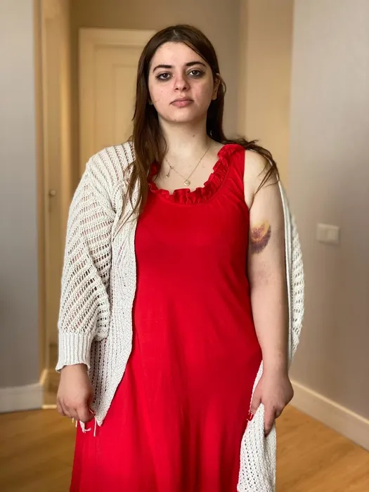 Arkadaşıyla plan yapıp eski nişanlısını ısırdı! İstanbul’da şaşkına çeviren olay