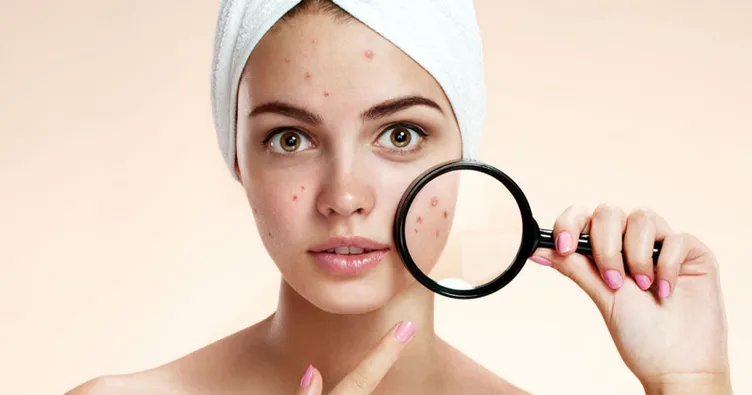 Sivilceye ne iyi gelir? Sivilce izleri nasıl geçer? İşte sivilce izlerini kurutan maske tarifleri