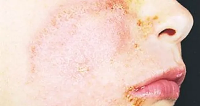 egzama nedir belirtileri ve tedavi