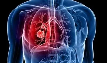 Akciğer enfeksiyonu belirtileri ve tedavisi: Akciğer enfeksiyonu neden olur, nasıl tedavi edilir?