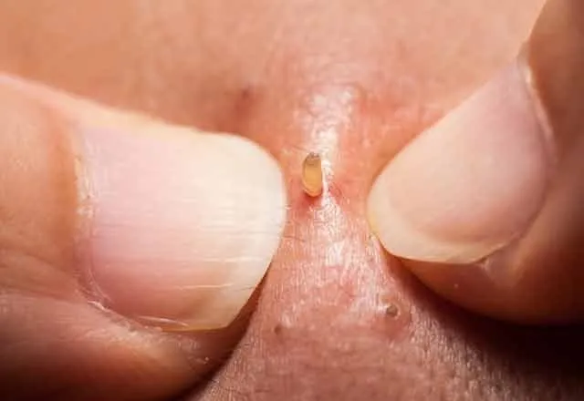 Siyah nokta temizleme yöntemleri