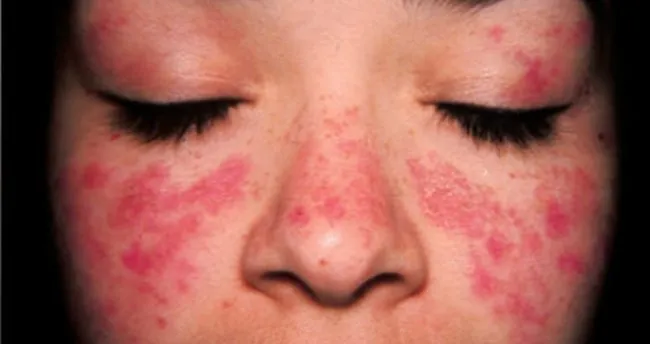 Lupus hastalığının belirtileri nelerdir? Lupus hastalığı bulaşıcı mıdır?