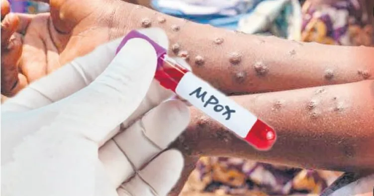 Gana’da maymun çiçeği kâbusu geri döndü