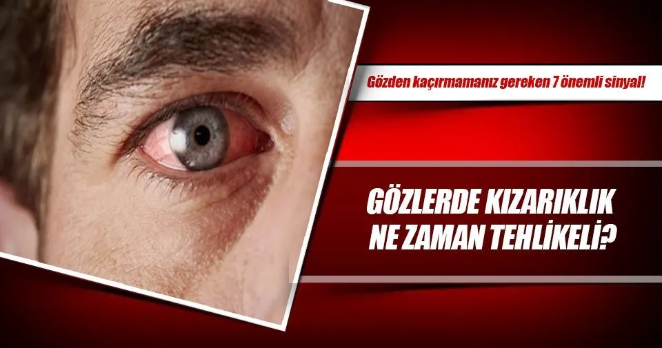 Gözlerde kızarıklık ne zaman tehlikeli? Sayfa 3 Sağlık Haberleri
