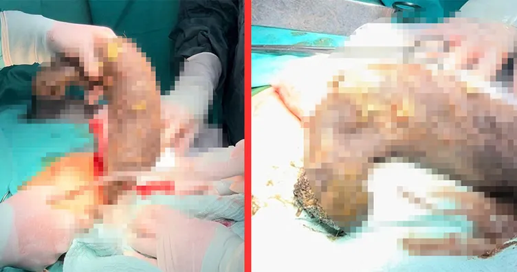 Doktorlar bile şaşkın: Midesinden 50 santim saç yumağı çıktı!