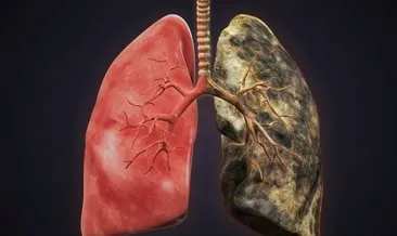 Akciğer sertleşmesinde erken tanı önemli