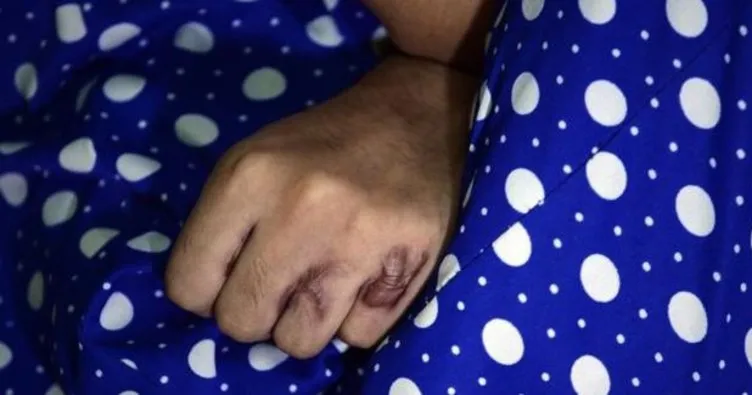 Kadına şiddetin böylesi: Beşinci kez asit saldırısına uğradı