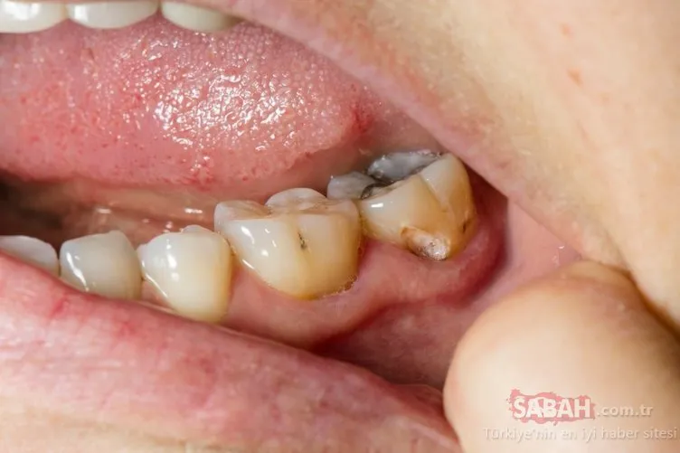 Diş çürüğünden kurtulmanın yolları nelerdir? İşte diş çürüğünden kurtulmanın püf noktaları