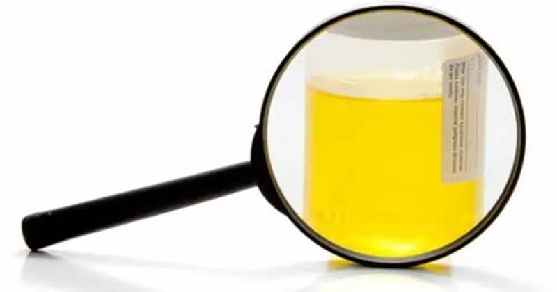 idrardan kan gelmesi hematuri neden