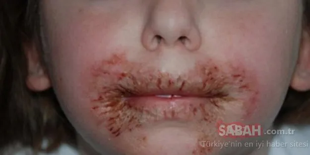 8 yaşındaki kızının yüzünde ciddi yaralar çıkıyordu... Doktor annenin araştırmasının sonucu korkunç oldu!