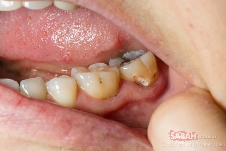Bu besin diş çürüğüne engel oluyor! İşte diş çürüğüne engel olan besinler