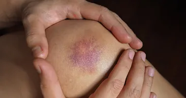 Vitamin eksikliğinin belirtileri