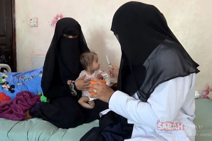 Yemen’de yaklaşık 85 bin çocuk yetersiz beslenmeden ölmüş olabilir
