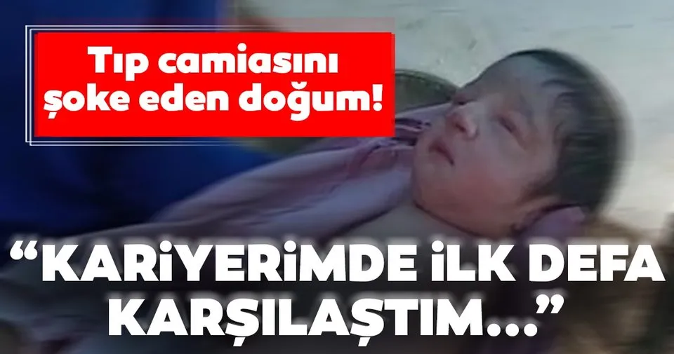 Kolları ve bacakları olmadan doğan bebek şaşkına çevirdi Kolları ve bacakları olmadan doğan bebek şaşkına çevirdi