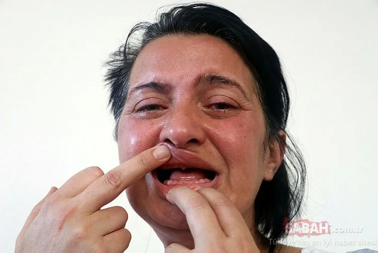 Antalya’da korkunç olay! ’Bembeyaz dişlerim olsun’ istedi, 32 dişinden oldu